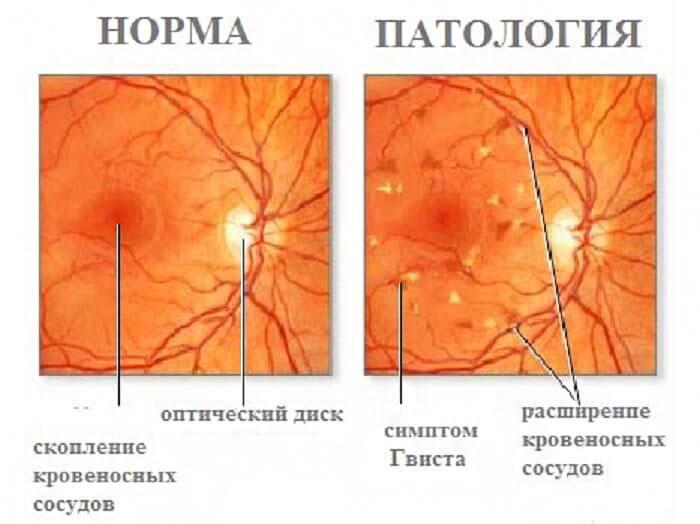 Retinal angiopathy