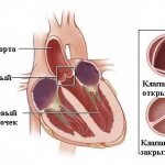 Aortic regurgitation (aortic valve insufficiency)