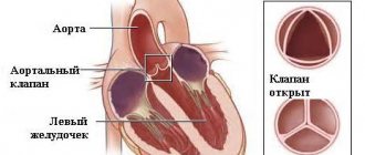 Аортальная недостаточность (недостаточность аортального клапана)