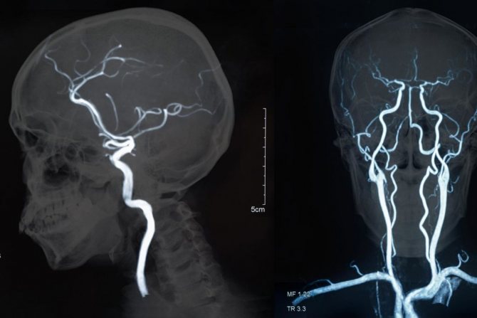 Cerebral angiography of cerebral vessels