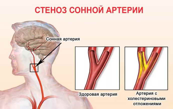 What is constriction of blood vessels