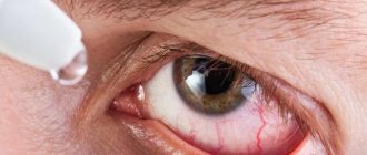 Что такое увеит глаза и как его лечить?