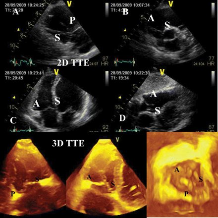 Diagnosis of TB prolapse using echocardiography
