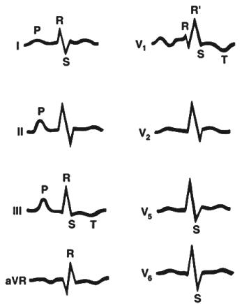 Элевация сегмента ST и инфаркт миокарда — E-Cardio