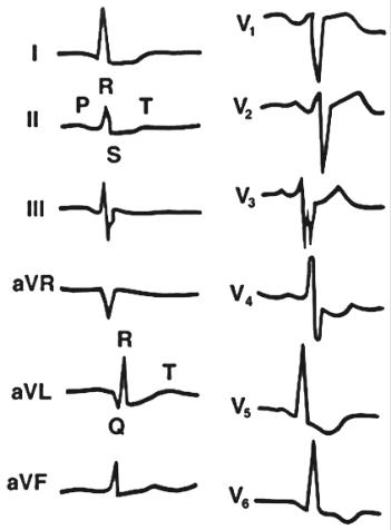 ST segment elevation and myocardial infarction – E-Cardio