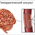 Геморрагический инсульт головного мозга