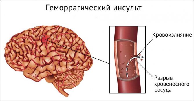 Геморрагический инсульт головного мозга