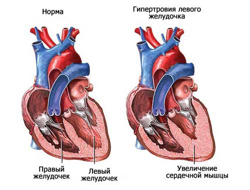 cardiac hypertrophy