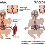 fetal hypoxia