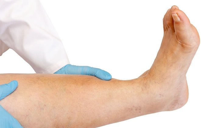 Как лечить тромб (тромбоз) в венах нижних конечностей (ног) и какие симптомы если он оторвался