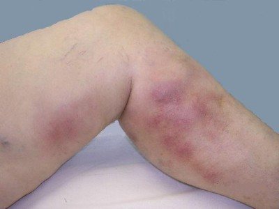 How to treat a blood clot (thrombosis) in the veins of the lower extremities (legs) and what are the symptoms if it comes off