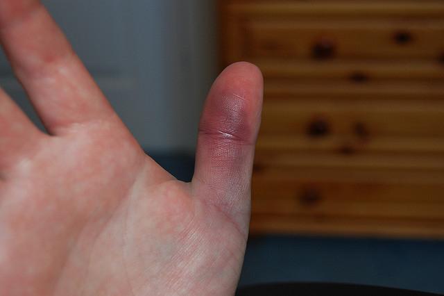 bruise on finger