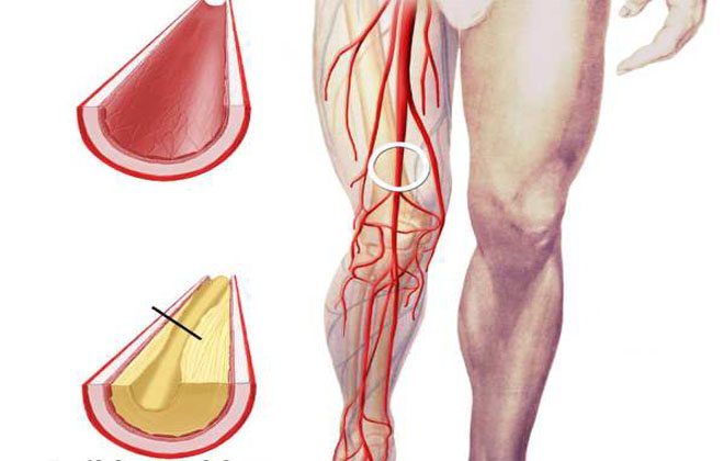Лечение и последствия стеноза бедренной артерии