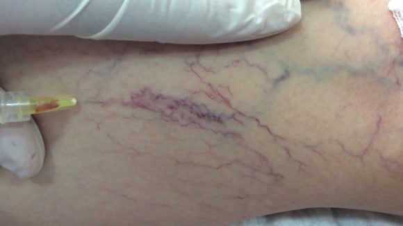Burst capillaries on leg photo
