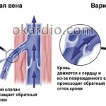механизм циркуляции крови в здоровых и варикозных венах