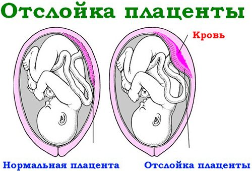 Normal and abruptio placenta