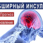 Обширный инсульт головного мозга: последствия и шансы выжить, ишемический и геморрагический тип, реабилитация, инсульт левого полушария, кома, после 80 лет