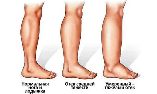 swelling in the lower extremities