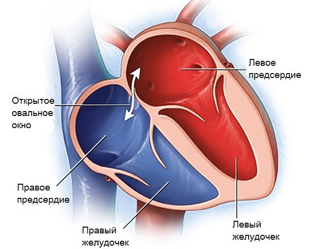 Patent foramen ovale in the heart