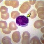 relative lymphocytosis