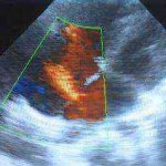 овальное окно в сердце у новорожденного 2 мм
