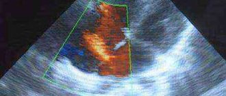 овальное окно в сердце у новорожденного 2 мм