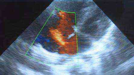 oval window in the heart of a newborn 2 mm