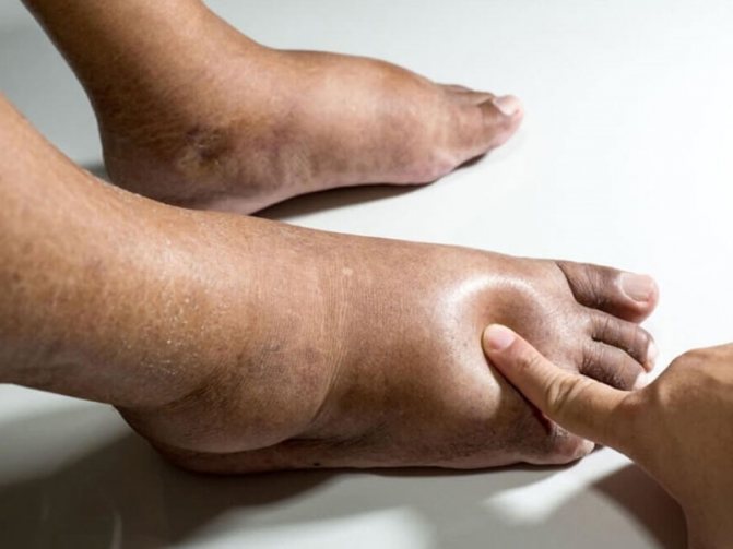 Pathologies that cause severe swelling of the lower extremities in the elderly