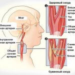 Causes of stenosis
