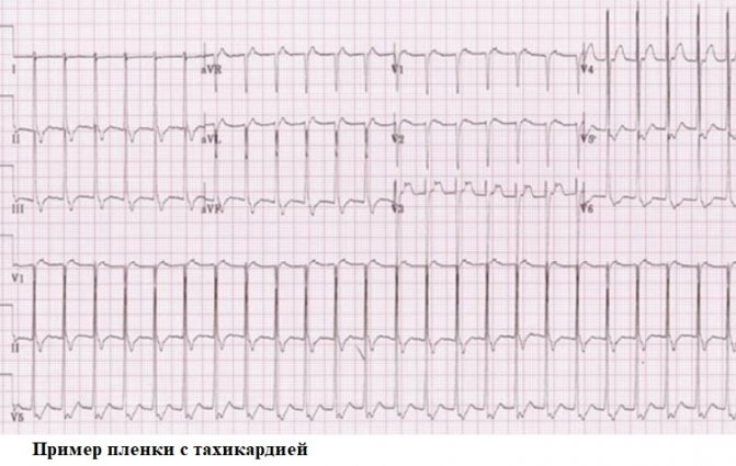 An example of a film with tachycardia