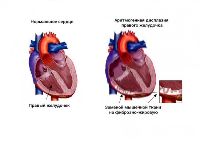 Signs of arrhythmogenic dysplasia of the right ventricle