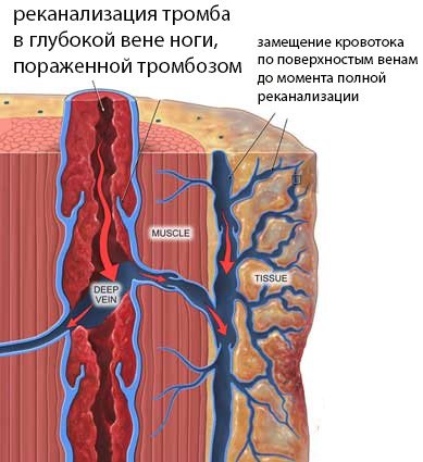 Реканализация тромбов: что это, как происходит – естественная, медикаментозная, хирургическая - Заболевания сердечно-сосудистой системы на 321news.ru