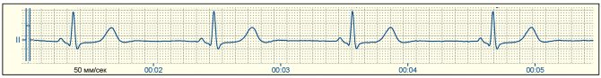 Rhythmogram of lead II with normal P wavesRhythmogram of lead II with normal P waves