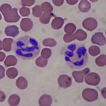 Segmented neutrophils are increased - common causes and diagnostic methods