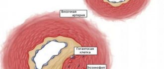 Сосуды, пораженные височным артериитом