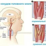 Спазм сосудов головного мозга: симптомы и лечение