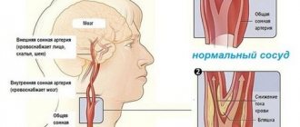 Спазм сосудов головного мозга: симптомы и лечение