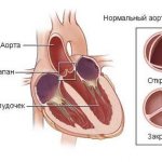 Стеноз легочной артерии у детей - подробная информация