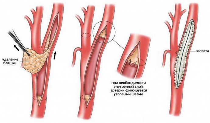 constriction of blood vessels
