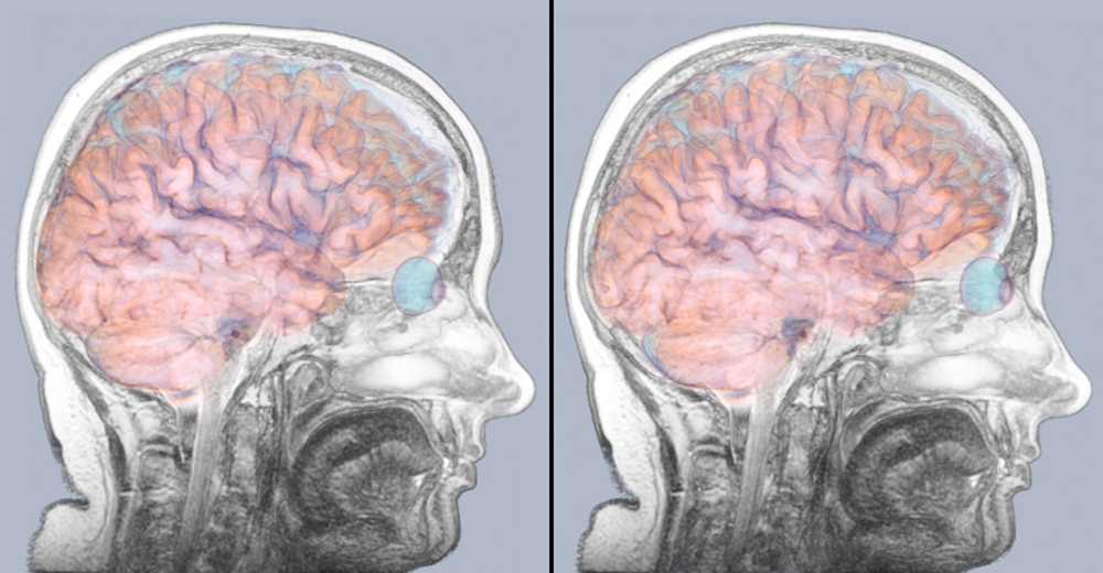 Brain tomography for stroke