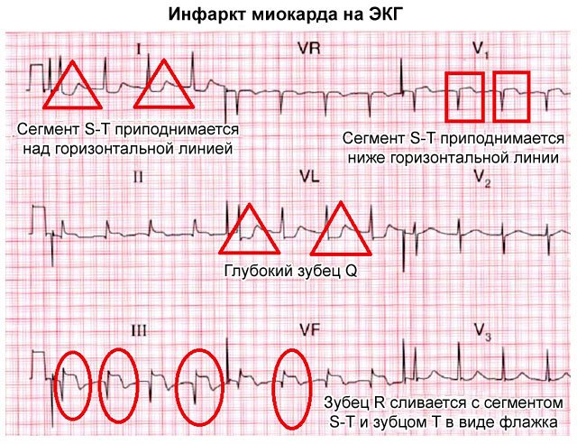 Topical diagnosis of myocardial infarction using ECG table