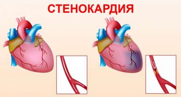We establish the correct dosages and types of drugs for the treatment of angina pectoris, their composition, analogues, prices and reviews