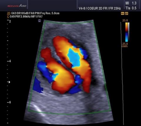 ultrasound of the heart