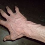 varicose veins on hands photo