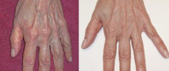 Варикоз на руках (фото): симптомы, причины, лечение