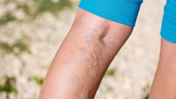 varicose veins and swelling