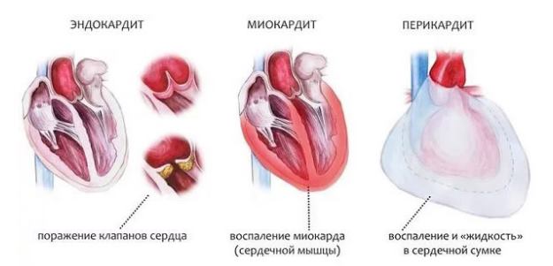 Заболевания сердца